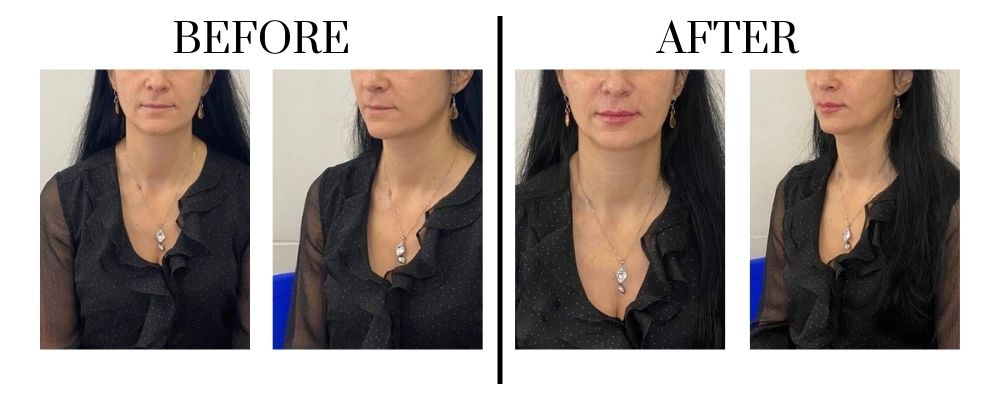 before-after-filler-ha